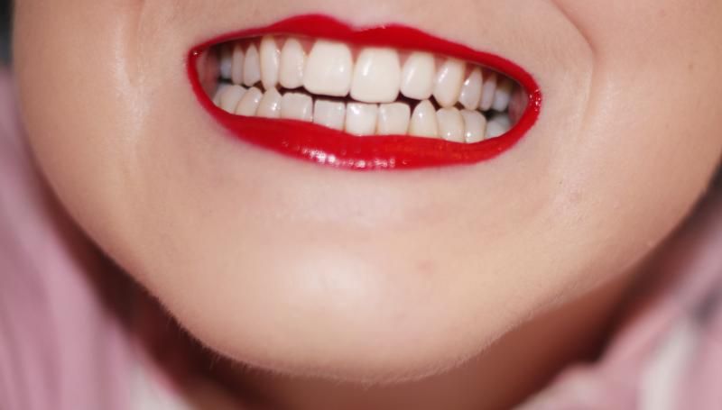 smile brilliant teeth whitening results