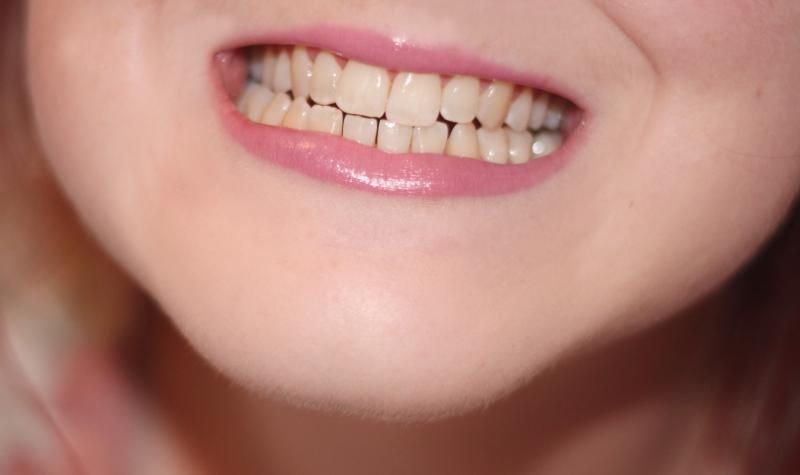 before teeth whitening