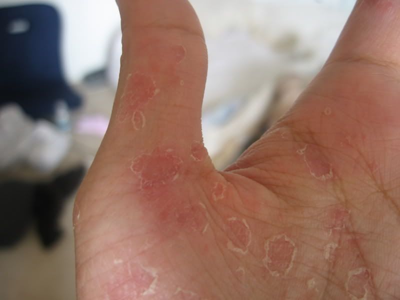 Peeling Skin Between Fingers mixecut