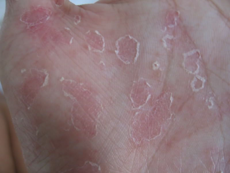 Peeling skin Causes - Mayo Clinic