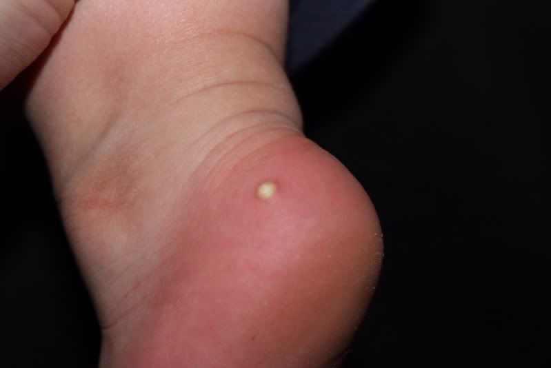 baby foot wart